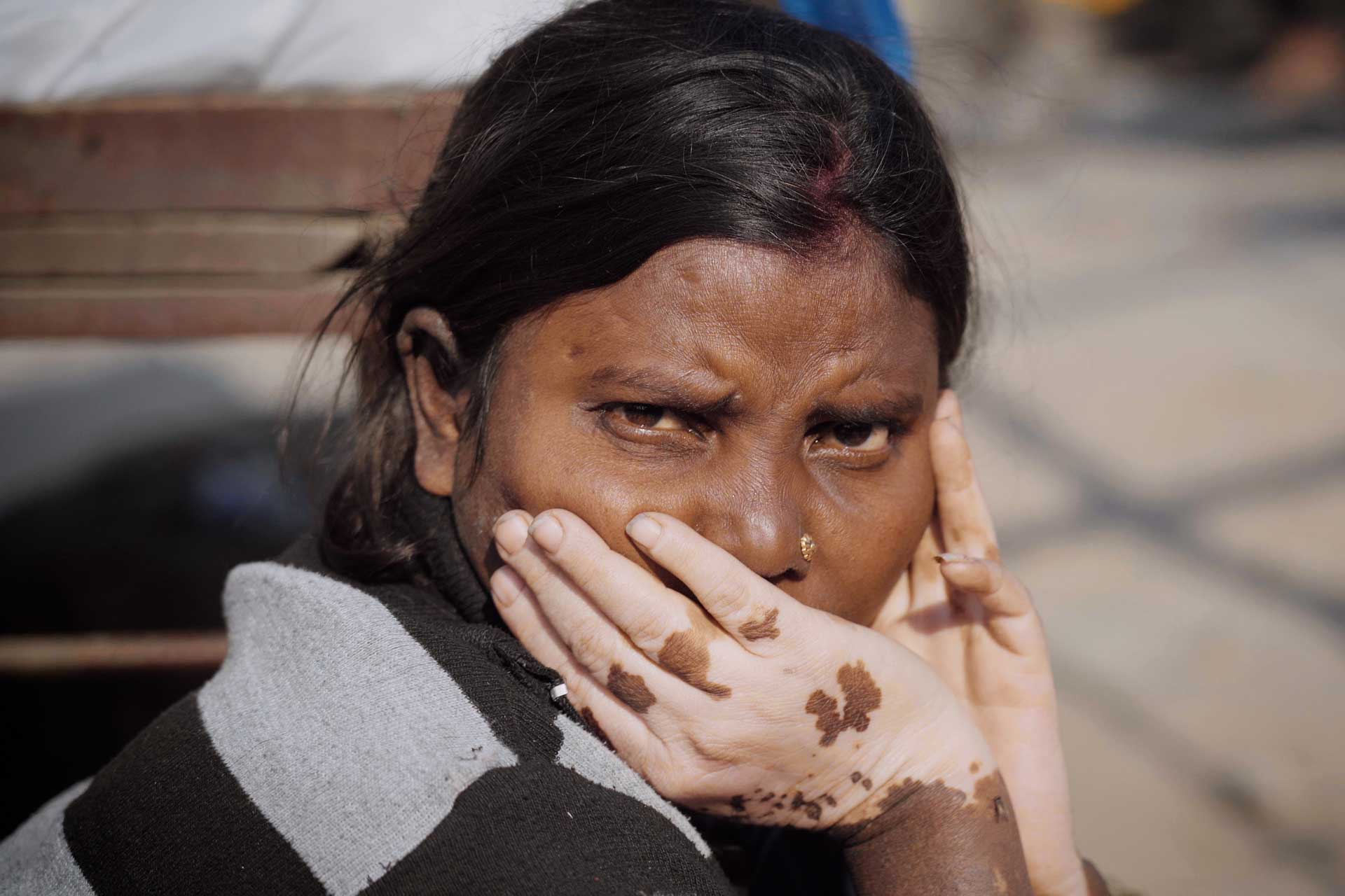 Image of a woman with skin discolouration from SLAY documentary film
